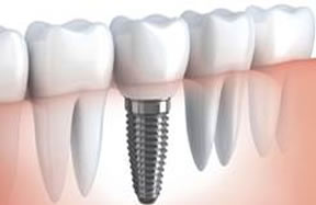 Implante - Oral Ipanpema