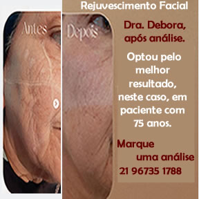 Preenchimento facial para qualquer idade. Com Debora Araujo, Trat. Estéticos
