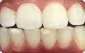 Exame clínico para alterações de esmalte Dra. Gláucia Athayde - DentistasRio.com.br