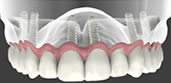 Prótese dentária Facial Odontologia - DentistasRio