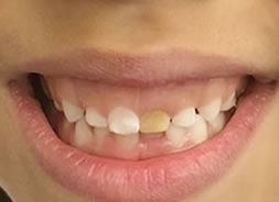 Dra Flávia dentista de crianças  Endodontia-Tratamento de Canal, 